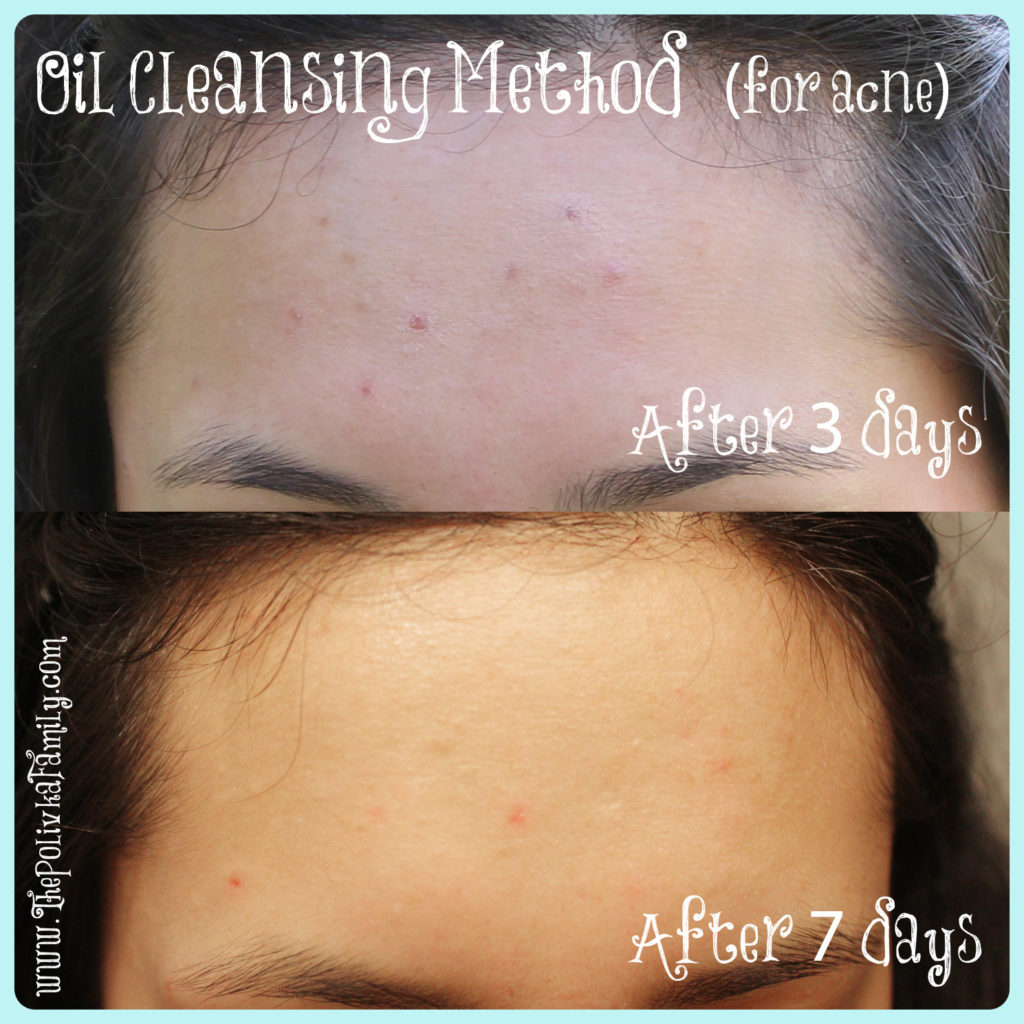 Oil washing sales for acne